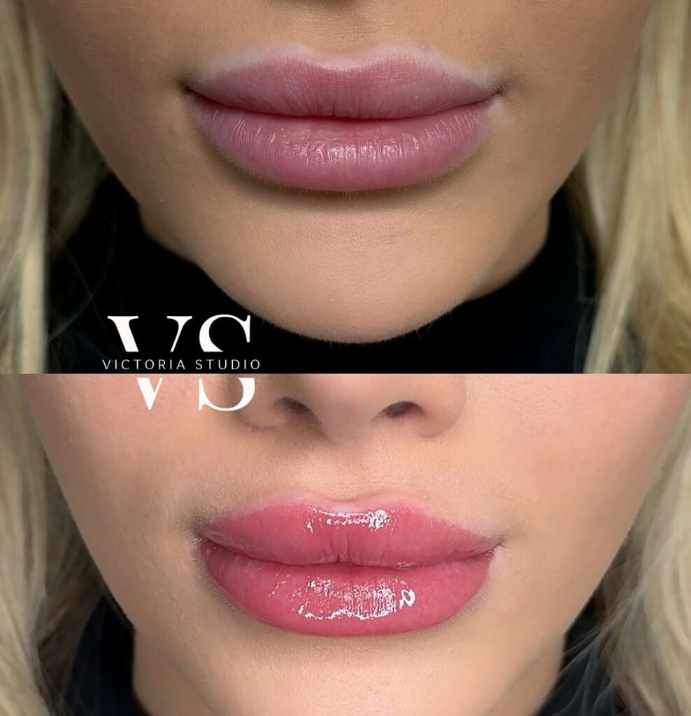 Before and after lip neutralization treatment showing even color correction