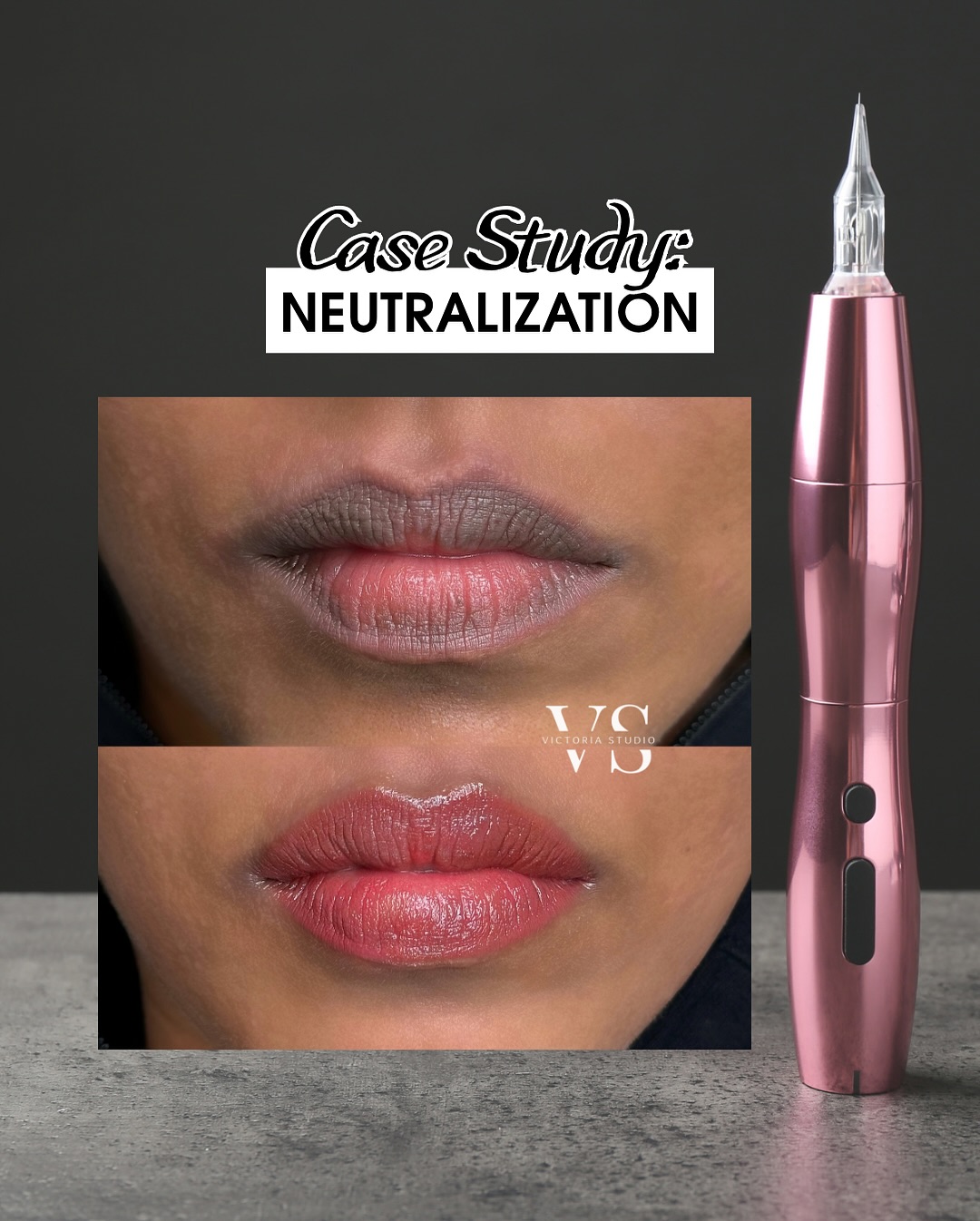 Say goodbye dark pigmentation on your lips ✨#lipblushing #lipblushingtoronto #lipblushingtrainin