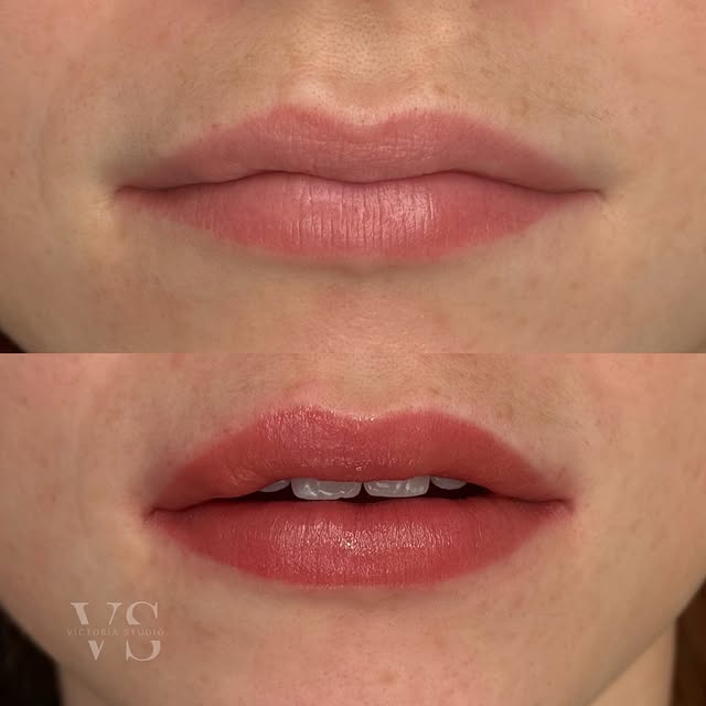 Lip neutralization before and after Toronto