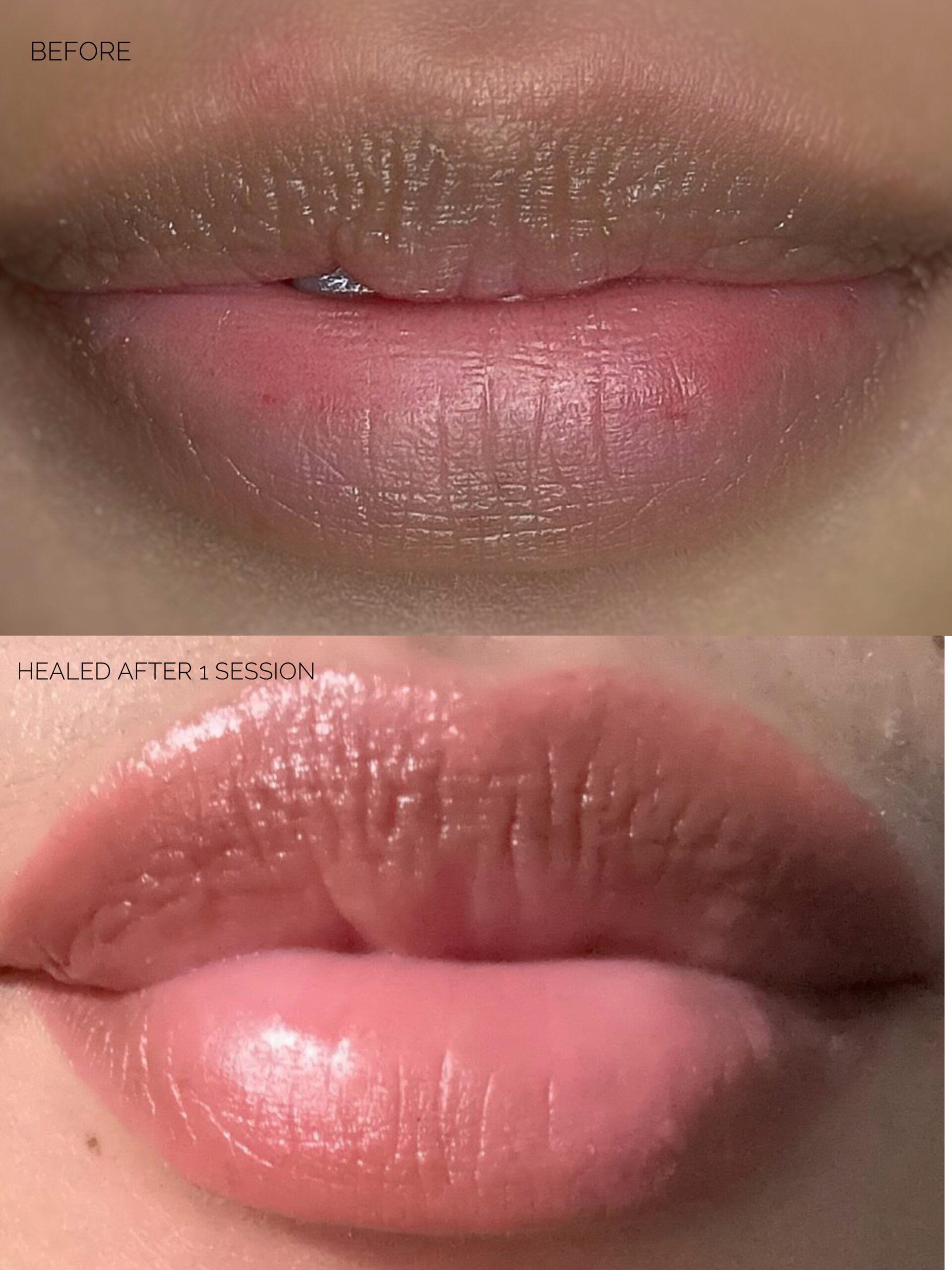 Before and after lip neutralization for dark lips at Victoria Studio Toronto