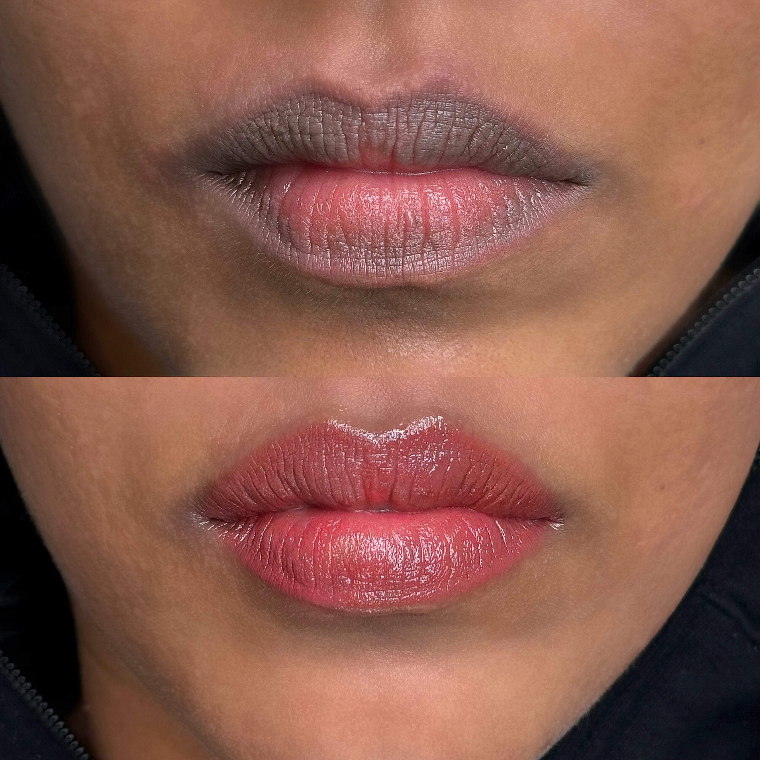 Healed lip neutralization results at Victoria Studio