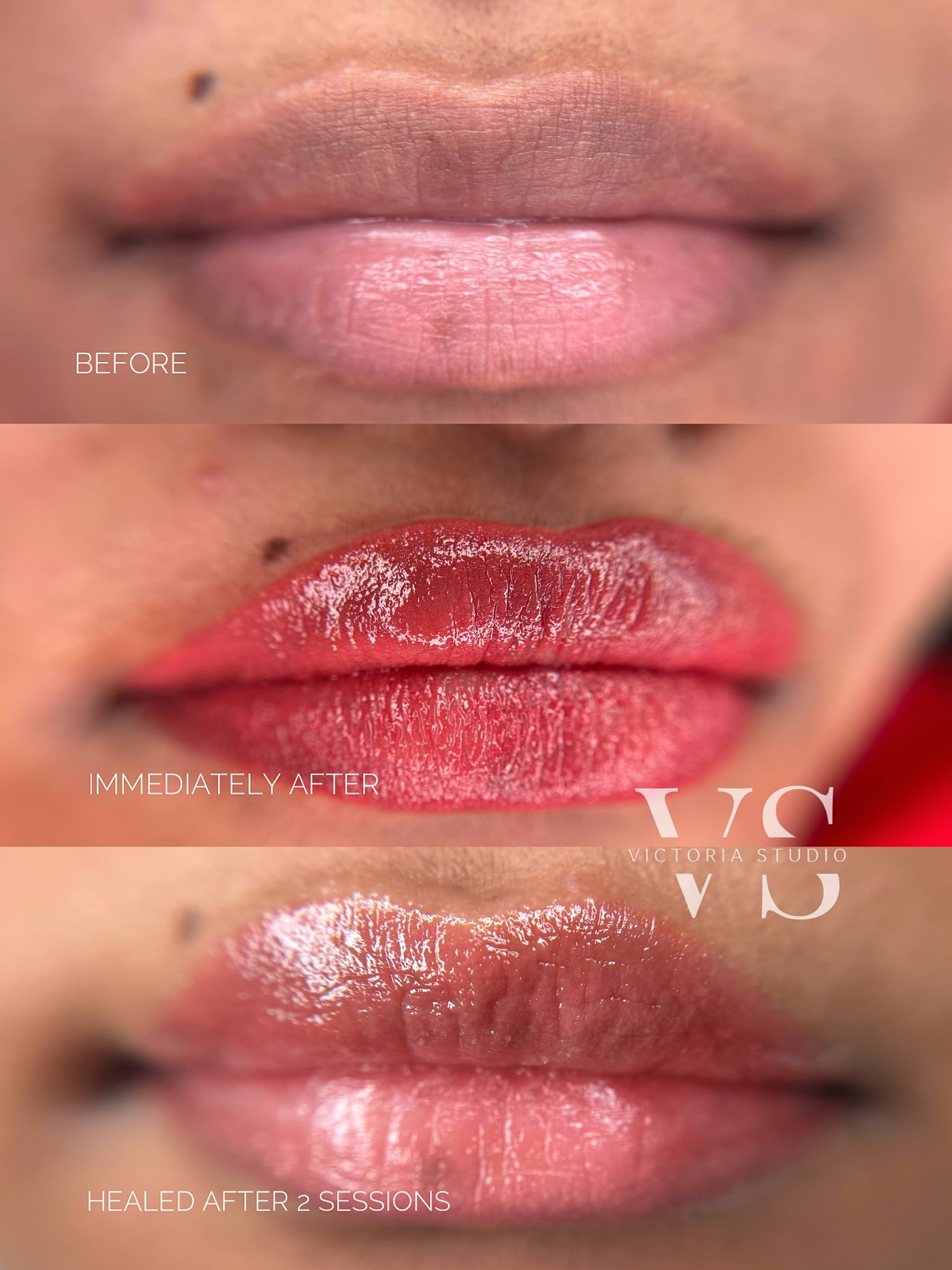 Dark lip permanent makeup correction in Etobicoke Toronto