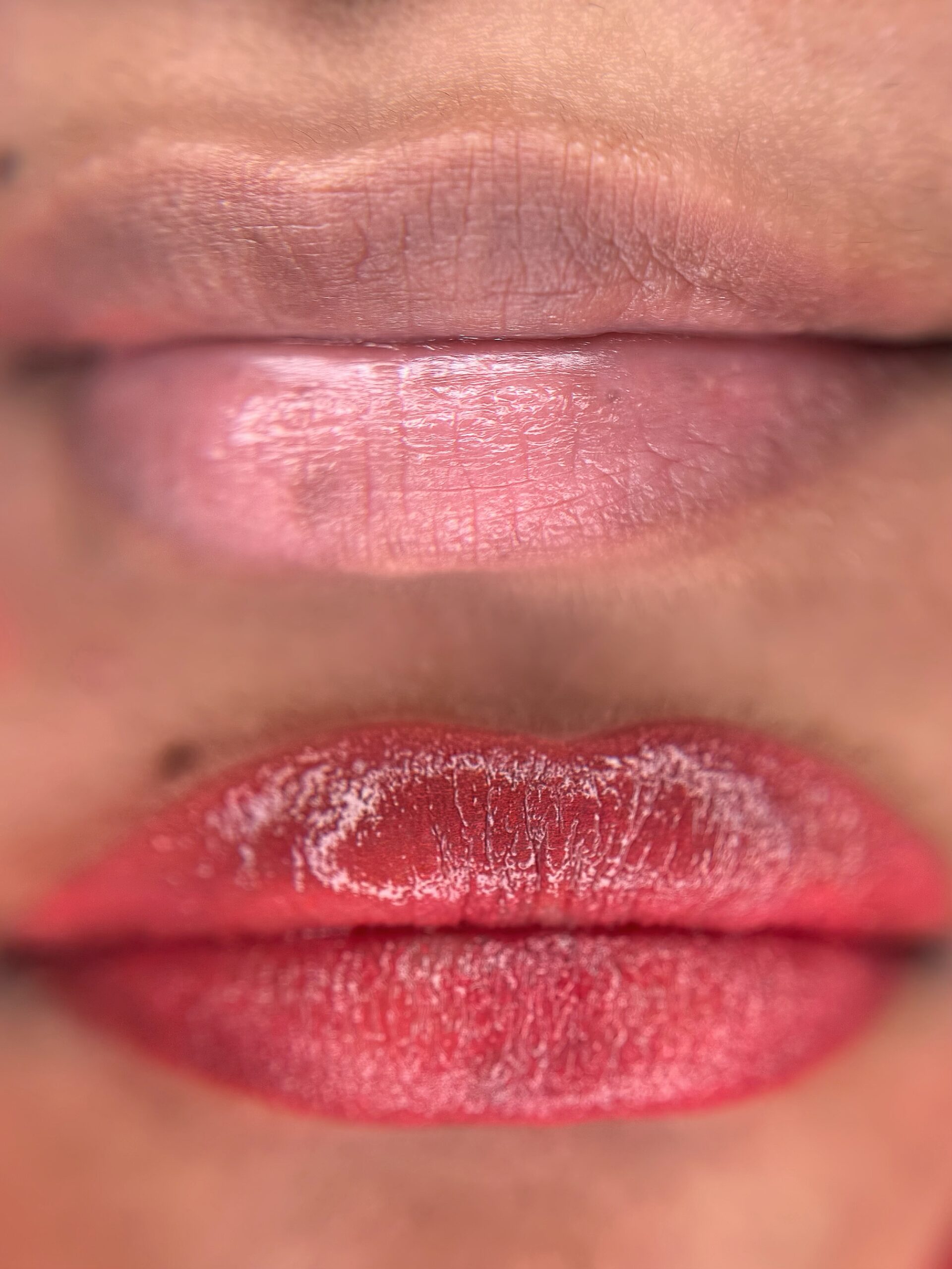 Healed lip neutralization results Toronto soft natural lip color after dark lip correction