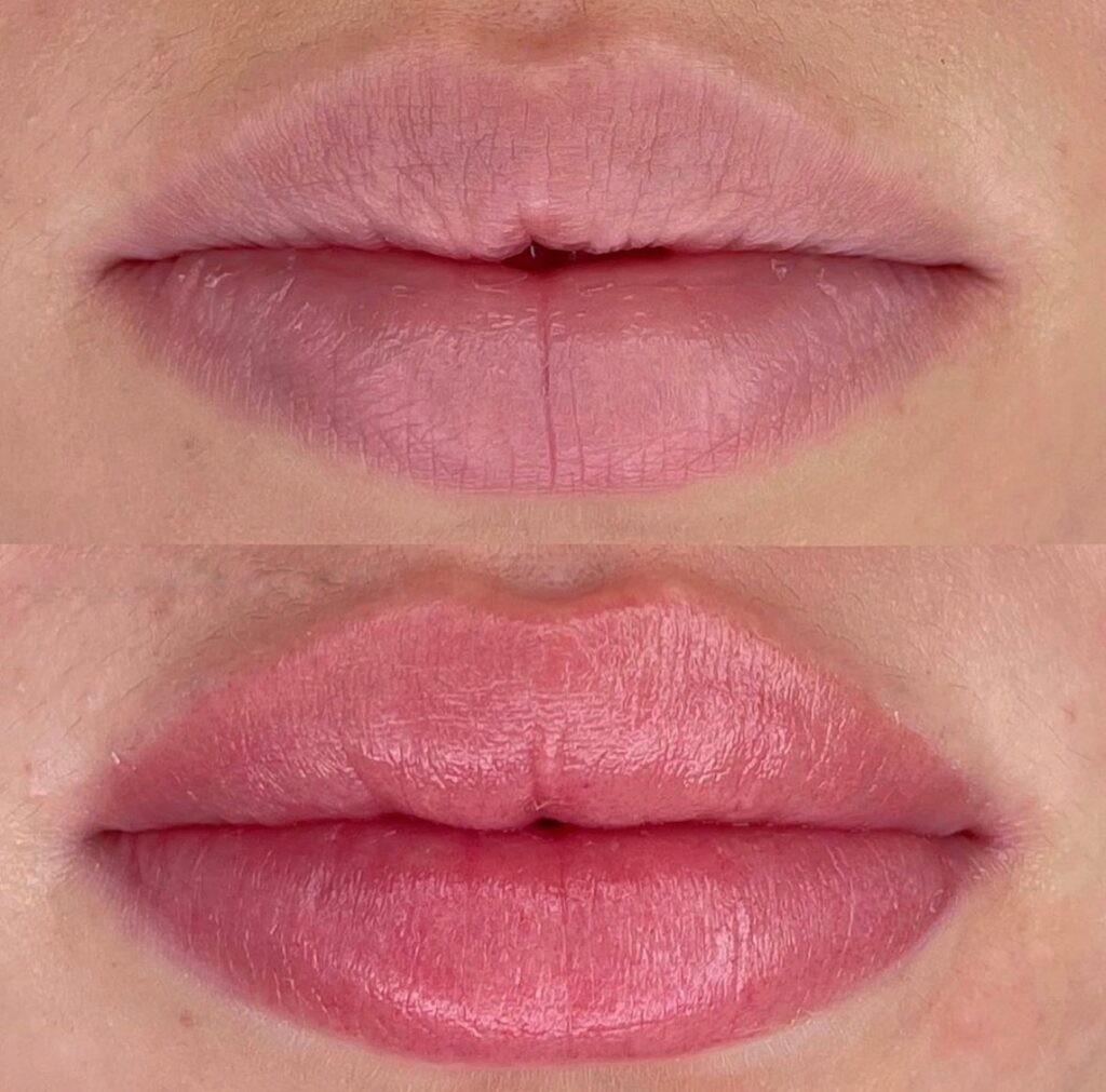 After Lip Filler, My Lips Still Have No Color — What Can I Do?