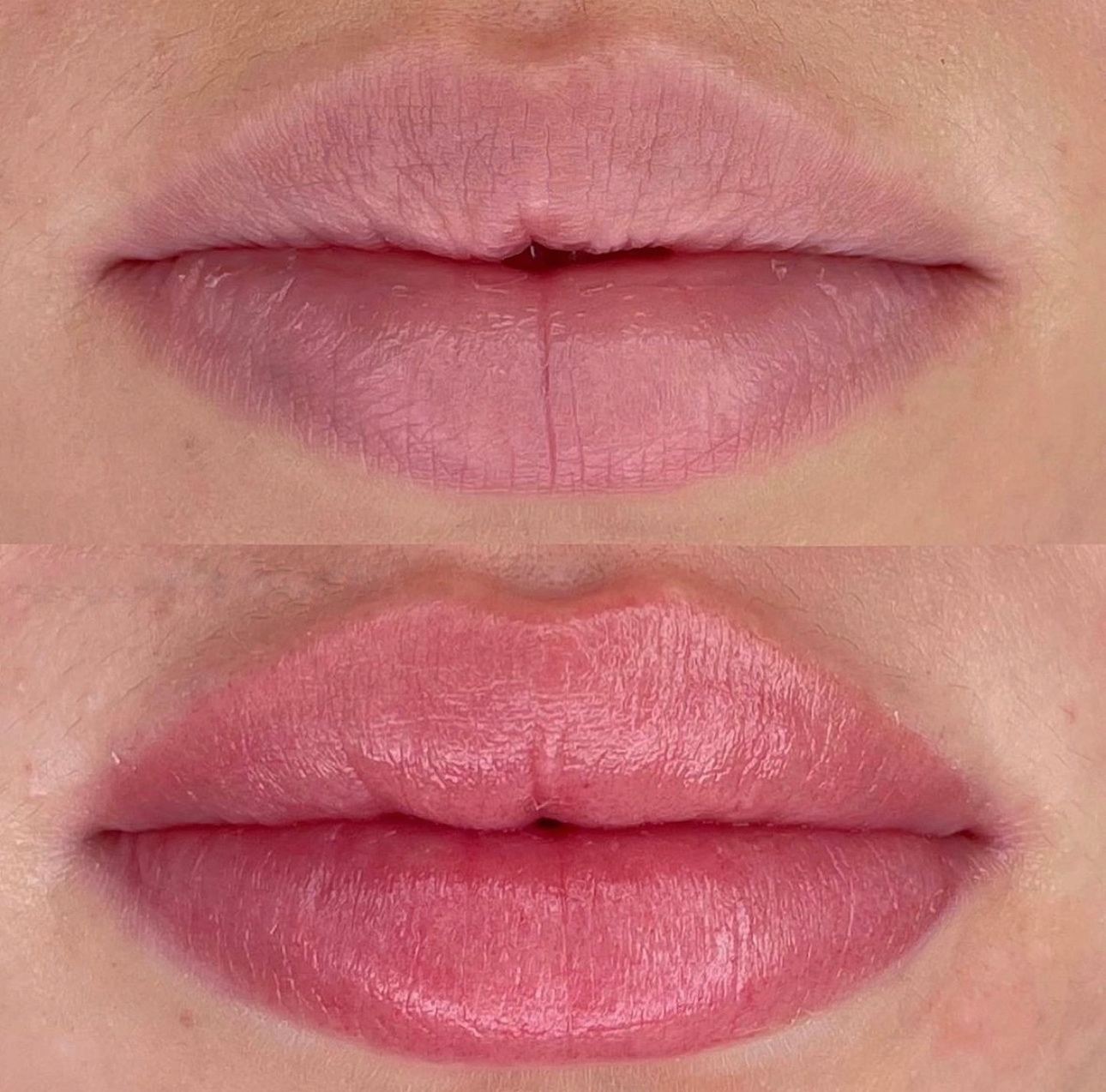 After Lip Filler, My Lips Still Have No Color — What Can I Do?