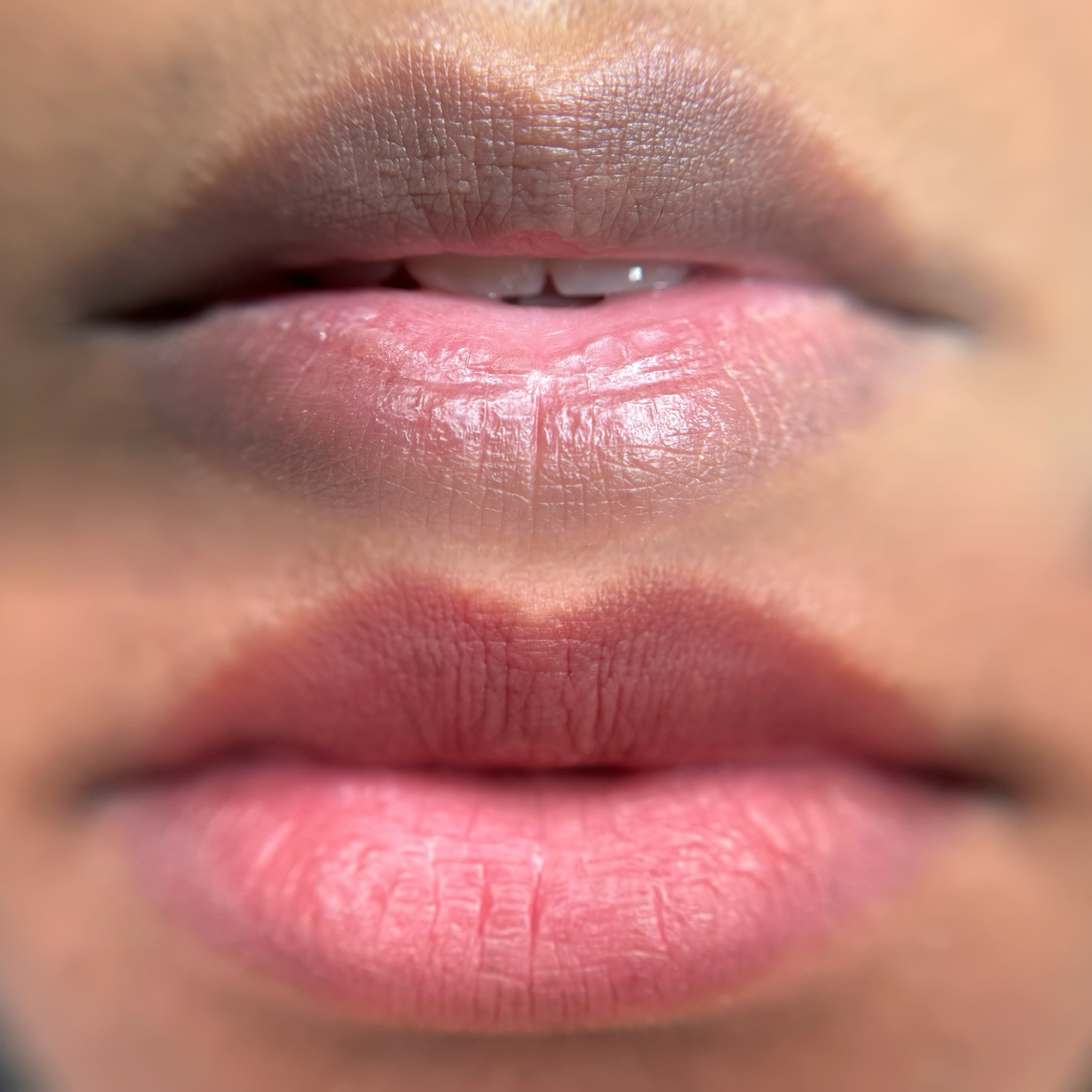 Lip neutralization treatment results on dark lips Toronto natural pink tone restored